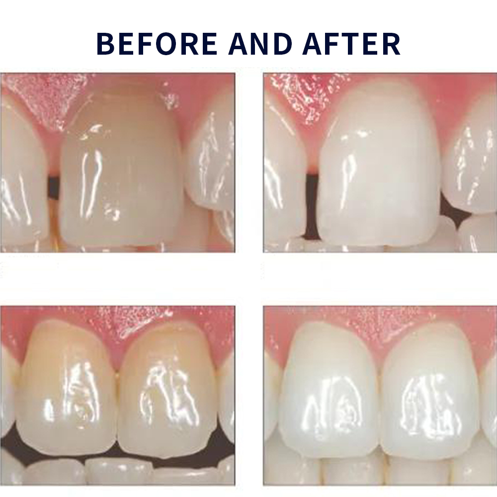 Opalescência Whitening Gel Kit - Teeth Whitening Before And After avaliação e preço