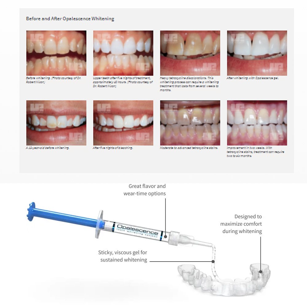 Opalescência Whitening Gel Kit - Teeth Whitening Before And After avaliação e preço