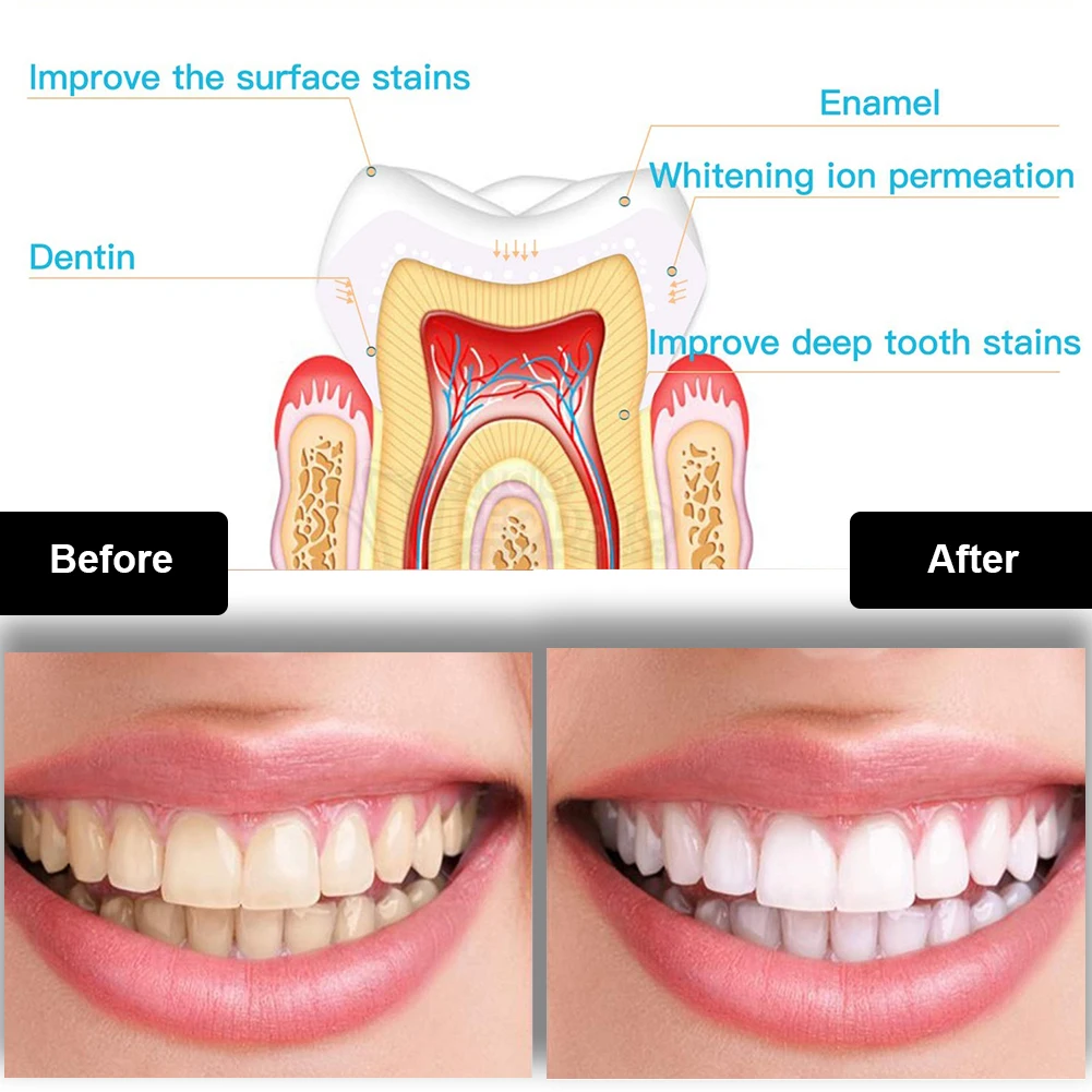 Kit de clareamento dental dos  - Teeth Whitening Before And After avaliação e preço