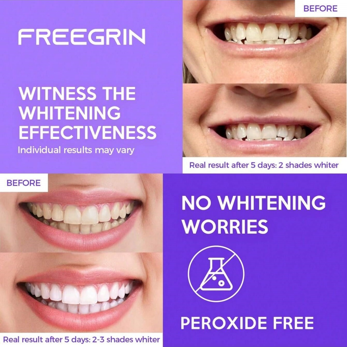 Adesivos de clareamento dental - Teeth Whitening Before And After avaliação e preço